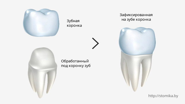 Восстановление зубов коронками в Минске