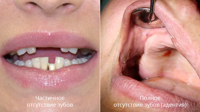Базальная имплантация зубов при адентии
