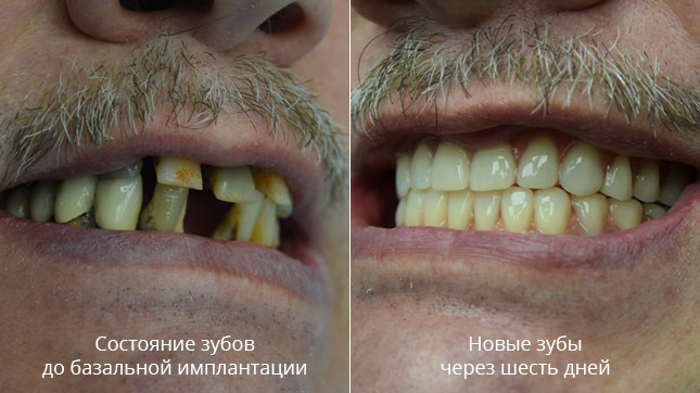 Базальная имплантация фото до и после