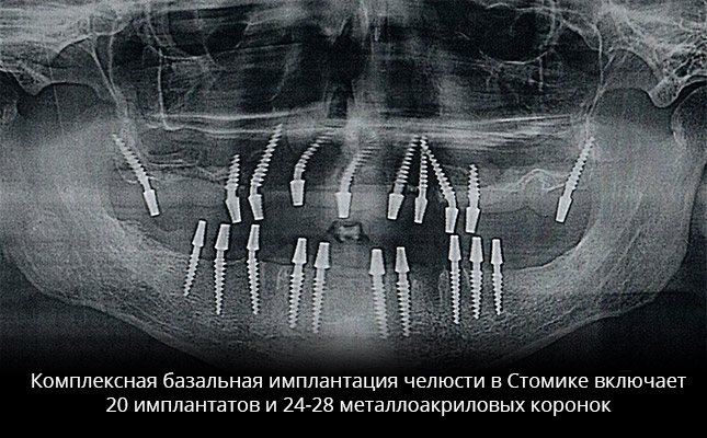 Базальная имплантация в комплексе: 20 имплантов, 24-28 коронок