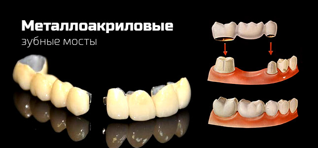 Зубной металлоакриловый мост