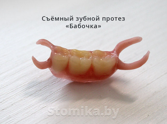 Съёмный зубной протез &laquo;Бабочка&raquo;