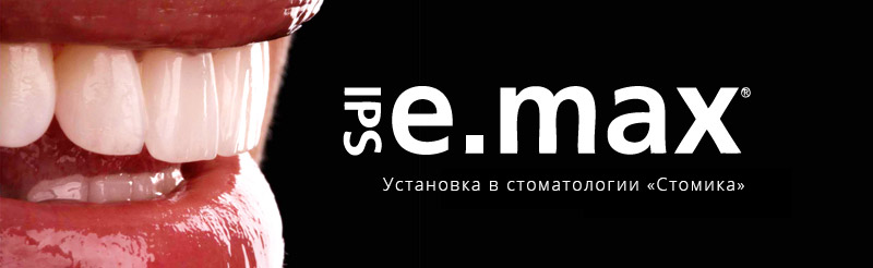 Виниры IPS E-Max в Минске по доступным ценам