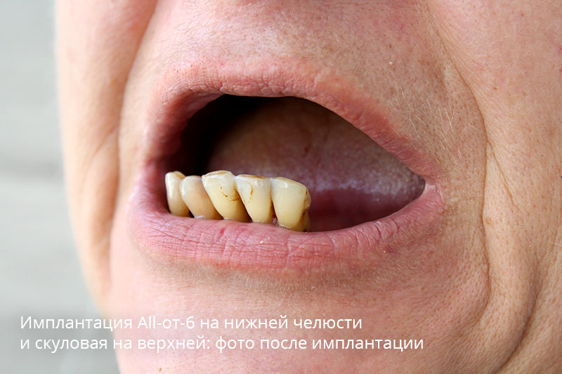 Полная имплантация зубов с использование скуловых: фото до и после 1