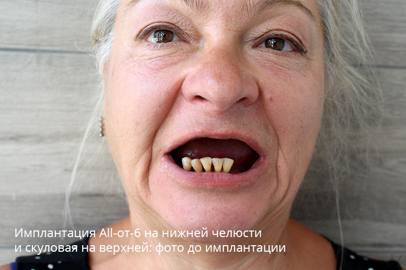 Полная имплантация зубов с использование скуловых: фото до и после 2