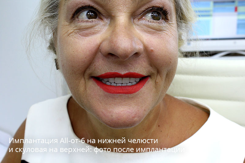 Полная имплантация зубов с использование скуловых: фото до и после 3