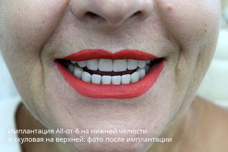 Полная имплантация зубов с использование скуловых: фото до и после 4