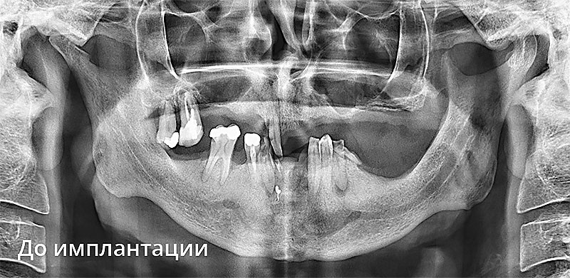 Состояние зубов пациента до скуловой имплантации | Фото до имплантации